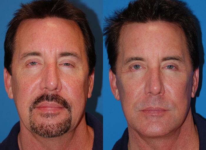 Male Facelift Photos | Melbourne, FL | Patient 29371